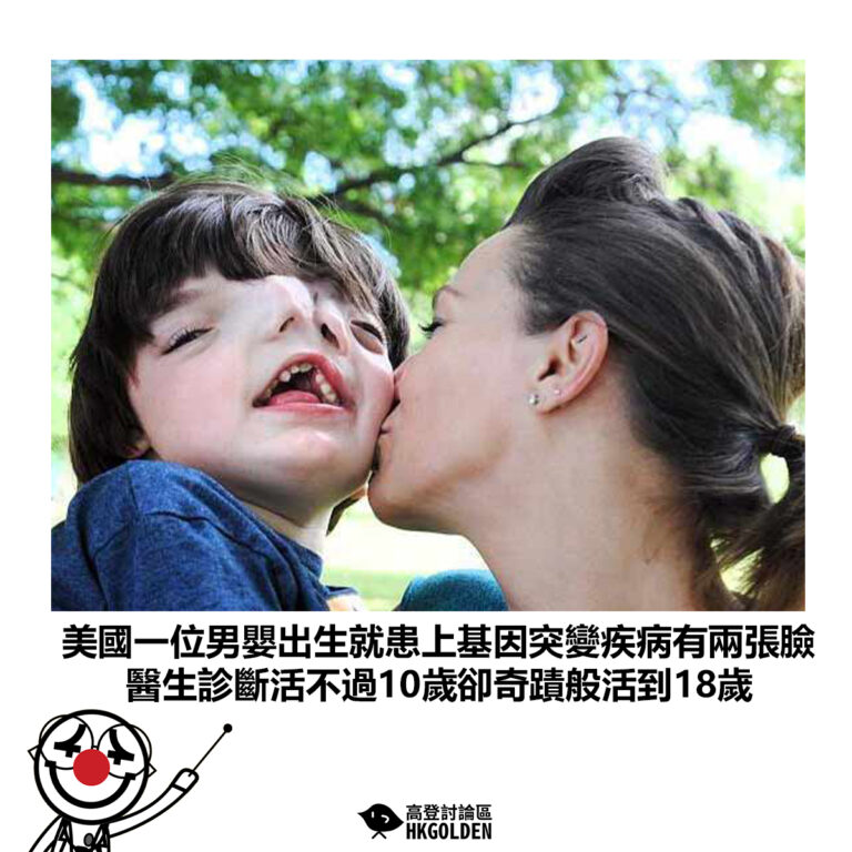 【美國一位男嬰出生就患上基因突變疾病有兩張臉   醫生診斷活不過10歲卻奇蹟般活到18歲】