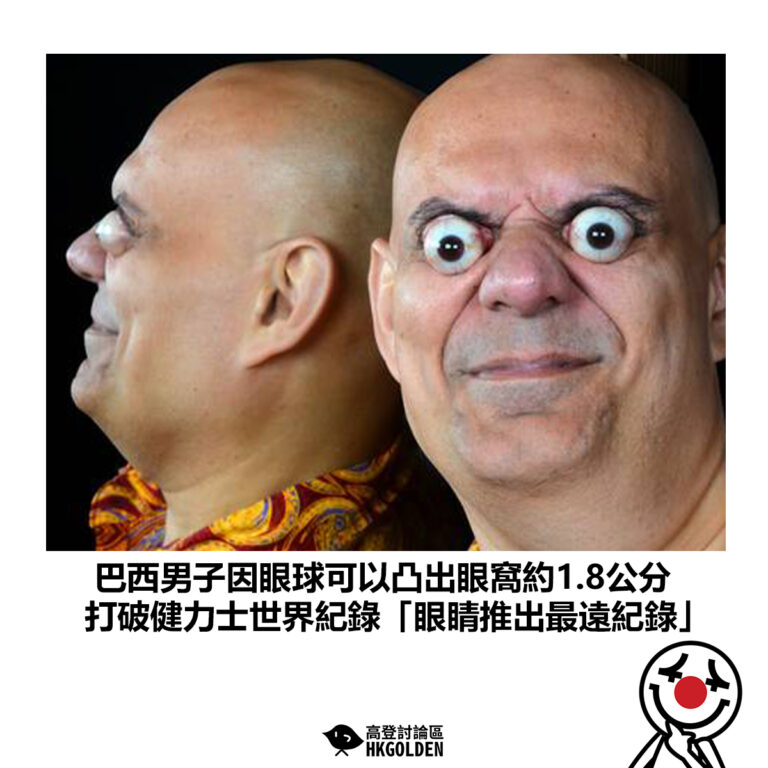 【巴西男子因眼球可以凸出眼窩約1.8公分  打破健力士世界紀錄「眼睛推出最遠紀錄」】