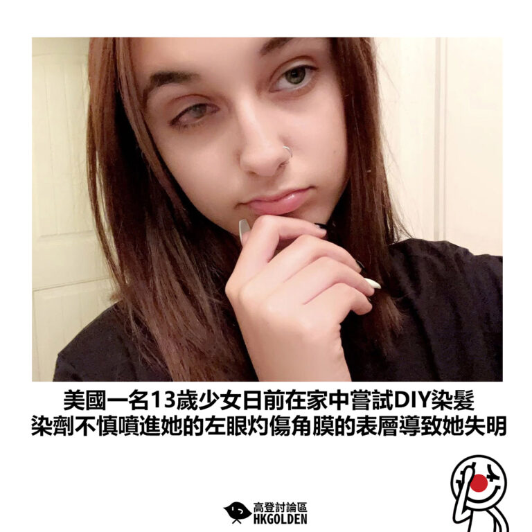 【美國一名13歲少女日前在家中嘗試DIY染髮 染劑不慎噴進她的左眼灼傷角膜的表層導致她失明 】