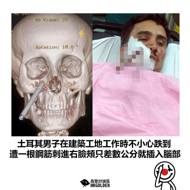 【土耳其男子在建築工地工作時不小心跌到 遭一根鋼筋刺進右臉頰只差數公分就插入腦部】