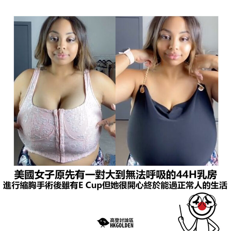 【美國女子原先有一對大到無法呼吸的44H乳房 進行縮胸手術後雖有E Cup但她很開心終於能過正常人的生活】