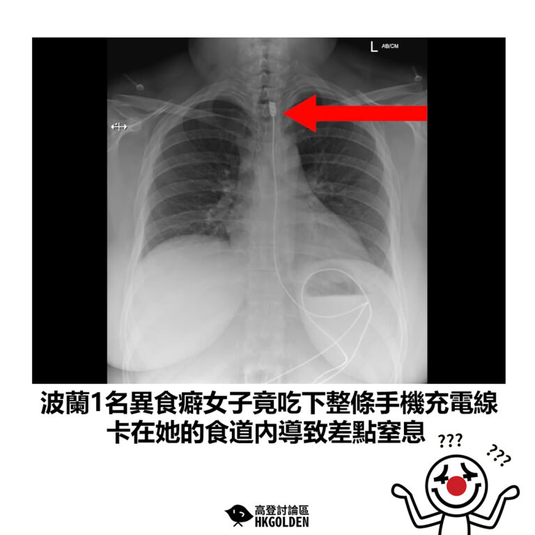 【波蘭1名異食癖女子竟吃下整條手機充電線 卡在她的食道內導致差點窒息】