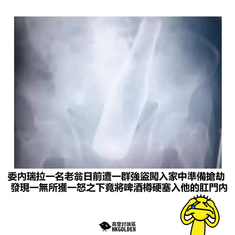 【委內瑞拉一名老翁日前遭一群強盜闖入家中準備搶劫 發現一無所獲一怒之下竟將啤酒樽硬塞入他的肛門內】
