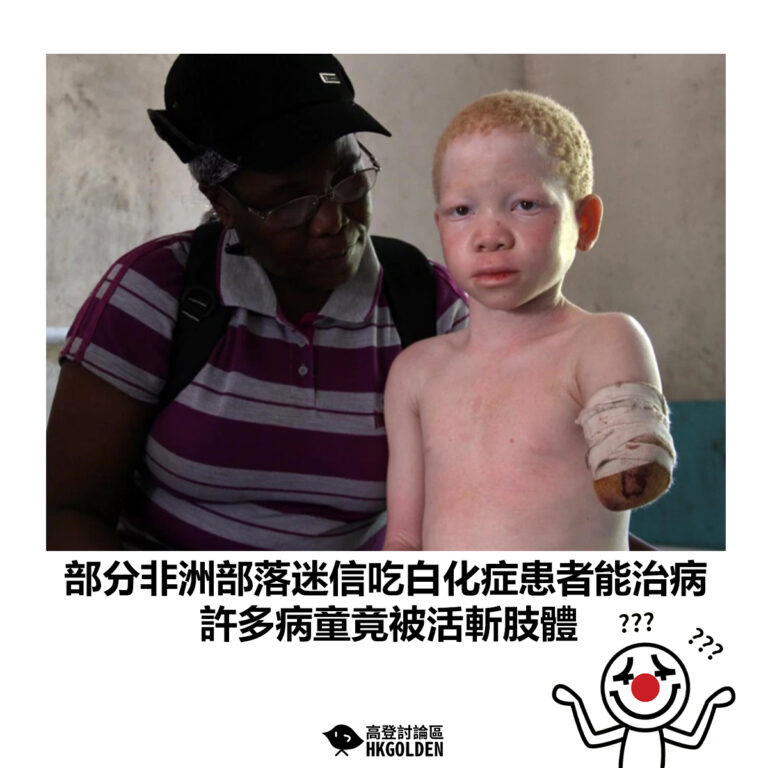 【部分非洲部落迷信吃白化症患者能治病 許多病童竟被活斬肢體 】