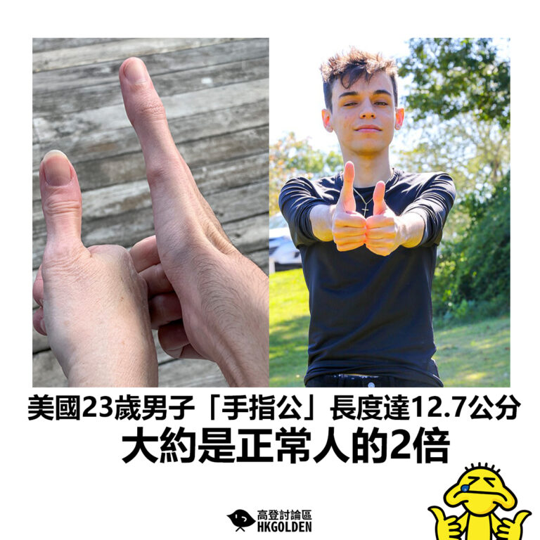 【美國23歲男子「手指公」長度達12.7公分 大約是正常人的2倍】