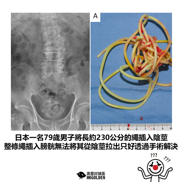 【日本一名79歲男子將長約230公分的繩插入陰莖 整條繩插入膀胱無法將其從陰莖拉出只好透過手術解決】