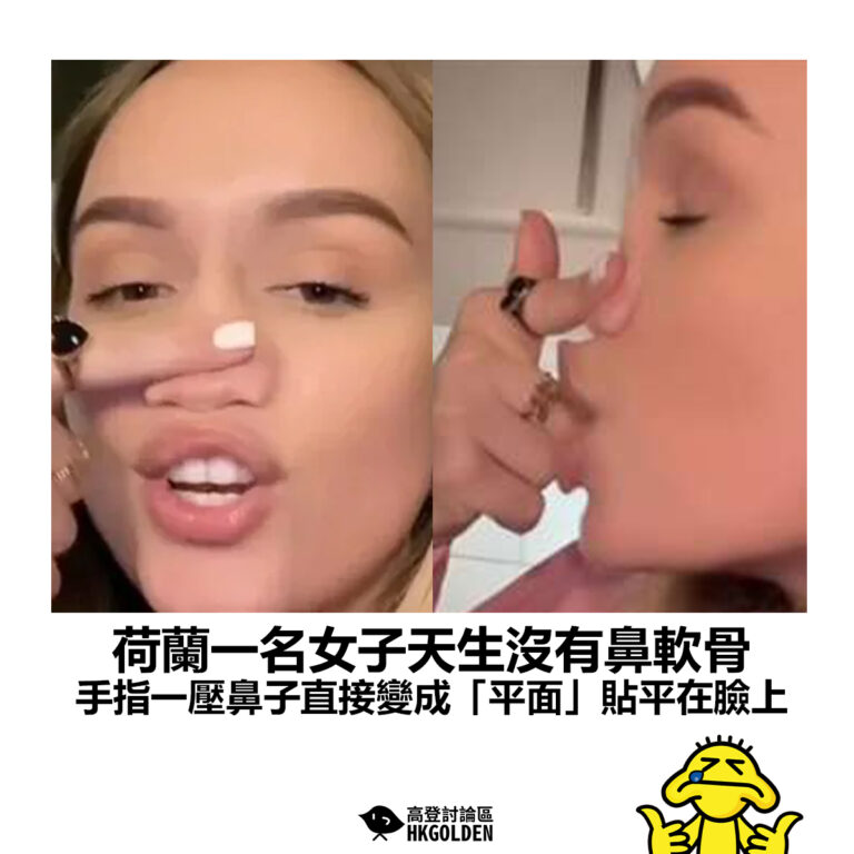 【荷蘭一名美女天生沒有鼻軟骨  用手指一壓鼻子直接變成「平面」貼平在臉上 】