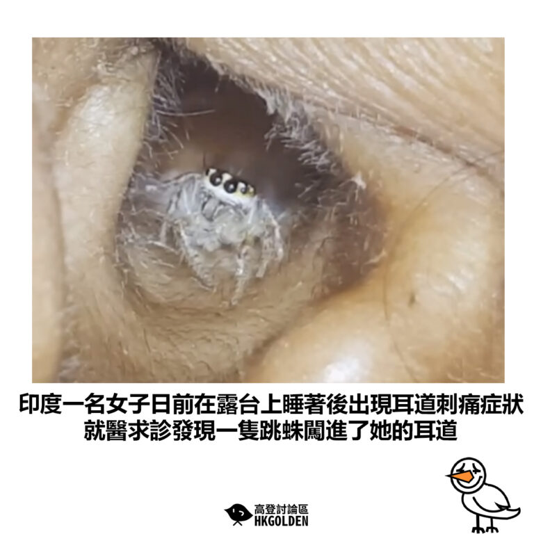 【印度一名女子日前在露台上睡著後出現耳道刺痛症狀 就醫求診發現一隻跳蛛闖進了她的耳道】