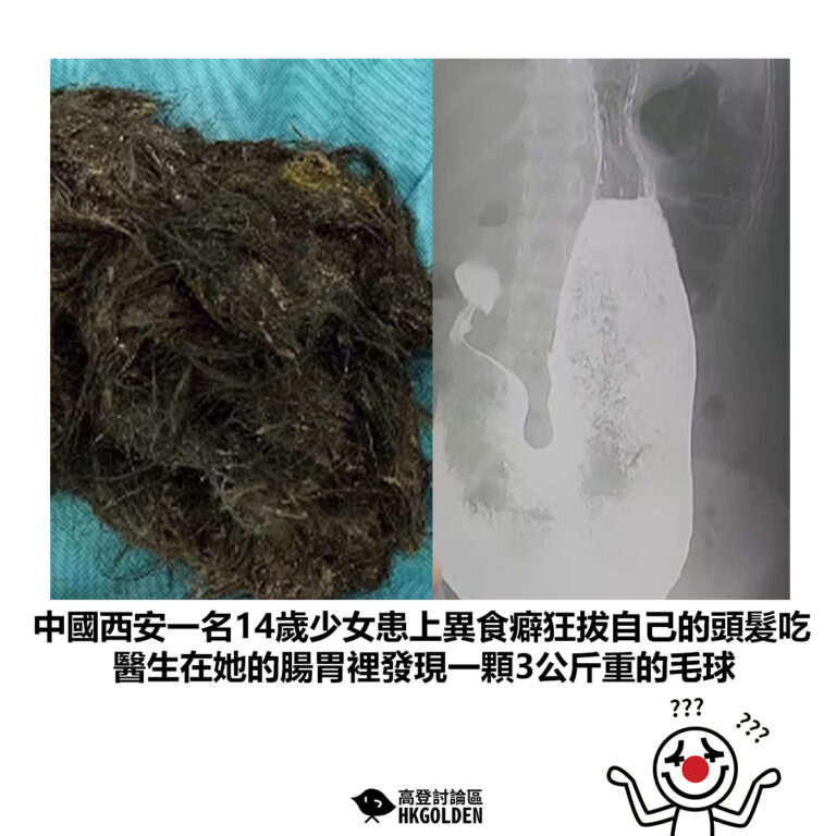【中國西安一名14歲少女患上異食癖狂拔自己的頭髮吃 醫生在她的腸胃裡發現一顆3公斤重的毛球】