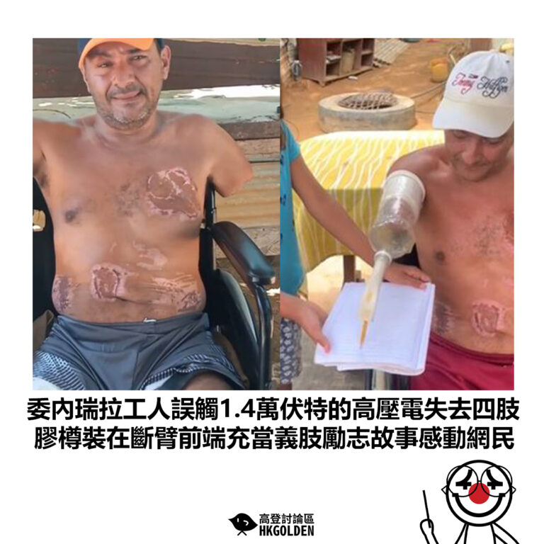 【委內瑞拉工人誤觸1.4萬伏特的高壓電失去四肢 膠樽裝在斷臂前端充當義肢勵志故事感動網民】