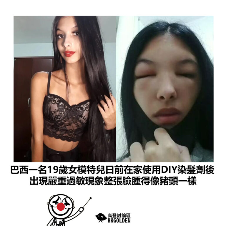 【巴西一名19歲女模特兒日前在家使用DIY染髮劑後 出現嚴重過敏現象整張臉腫得像豬頭一樣】