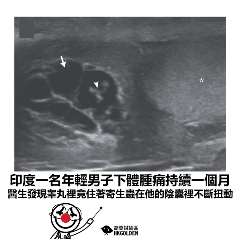 【印度一名年輕男子下體腫痛持續一個月 醫生發現睾丸裡竟住著寄生蟲在他的陰囊裡不斷扭動】