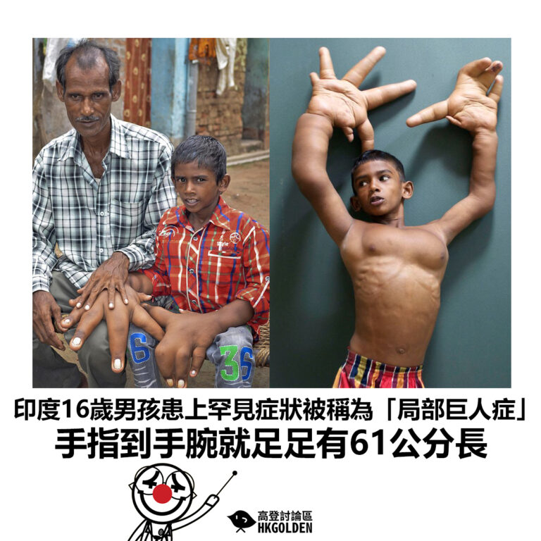 【印度16歲男孩患上罕見症狀被稱為「局部巨人症」手指到手腕就足足有61公分長】