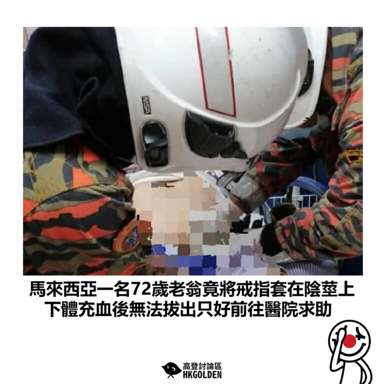 【馬來西亞一名72歲老翁竟將戒指套在陰莖上 下體充血後無法拔出只好前往醫院求助 】