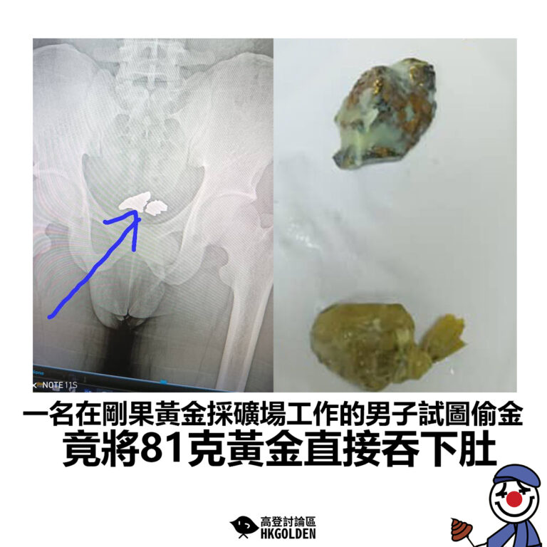 【一名在剛果黃金採礦場工作的男子試圖偷金 竟將81克黃金直接吞下肚】