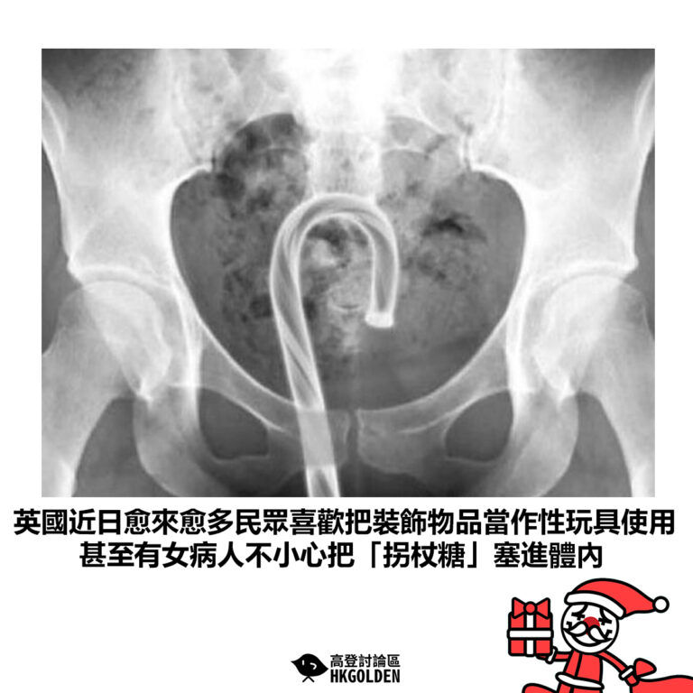 【英國近日愈來愈多民眾喜歡把裝飾物品當作性玩具使用 甚至有女病人不小心把「拐杖糖」塞進體內】