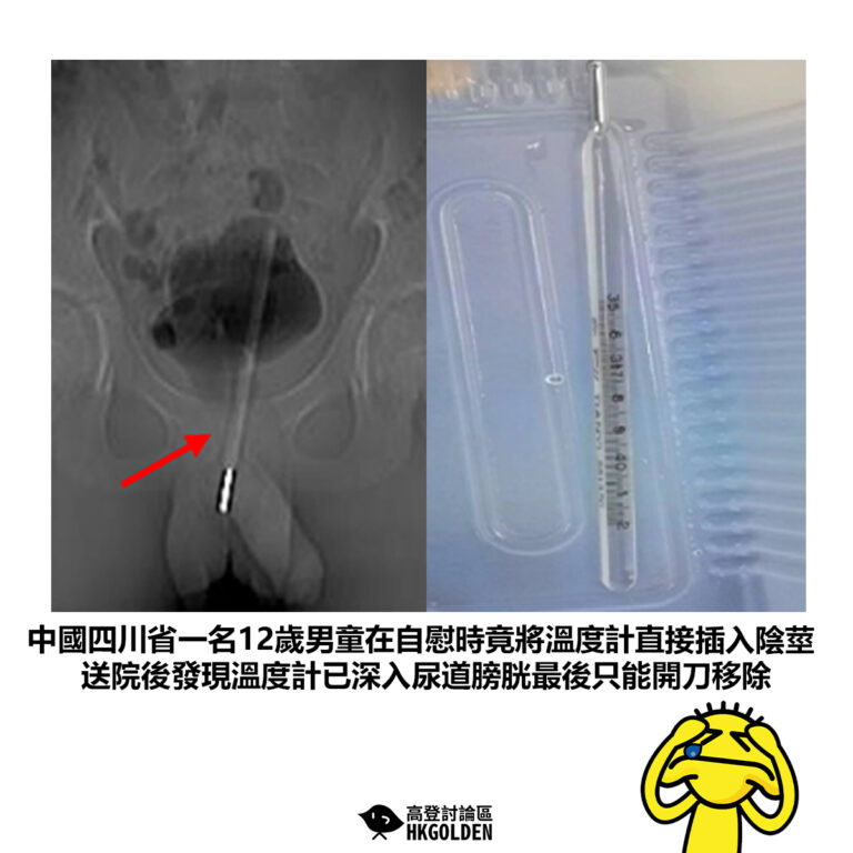 【中國四川省一名12歲男童在自慰時竟將溫度計直接插入陰莖 送院後發現溫度計已深入尿道膀胱最後只能開刀移除】