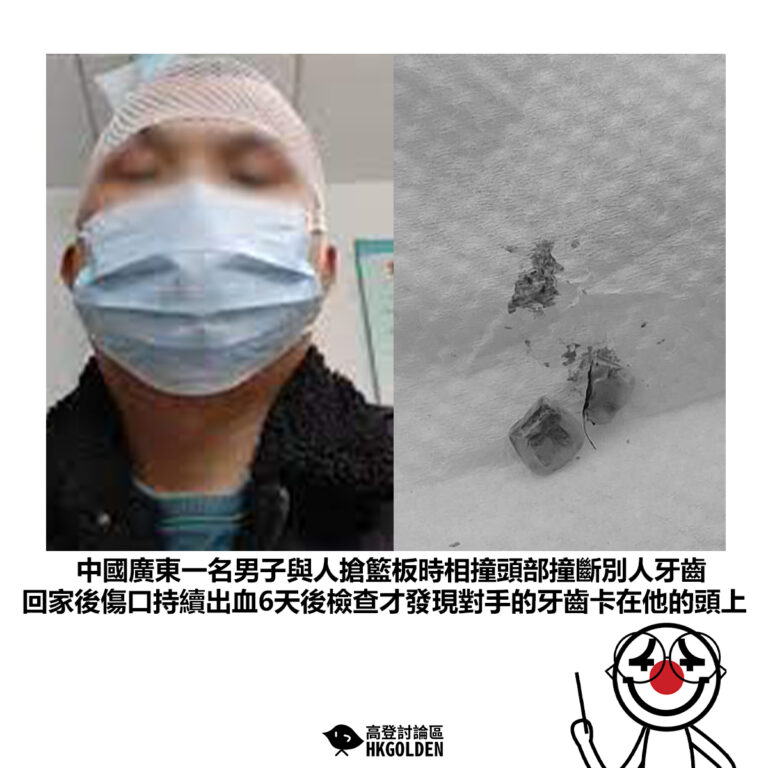 【中國廣東一名男子與人搶籃板時相撞頭部撞斷別人牙齒 回家後傷口持續出血6天後檢查才發現對手的牙齒卡在他的頭上】