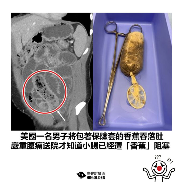 【美國一名男子將包著保險套的香蕉吞落肚 嚴重腹痛送院才知道小腸已經遭「香蕉」阻塞】