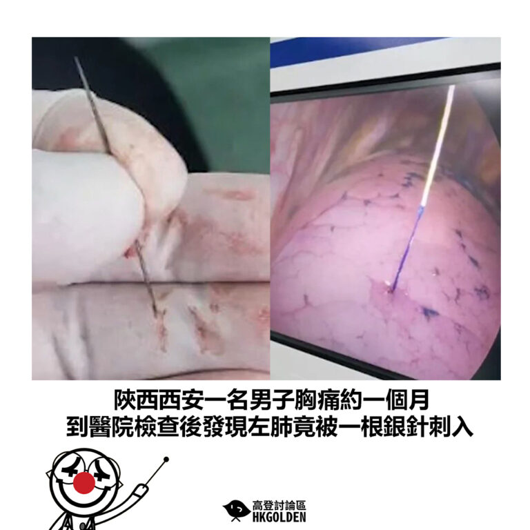 【陝西西安一名男子胸痛約一個月 到醫院檢查後發現左肺竟被一根銀針刺入】
