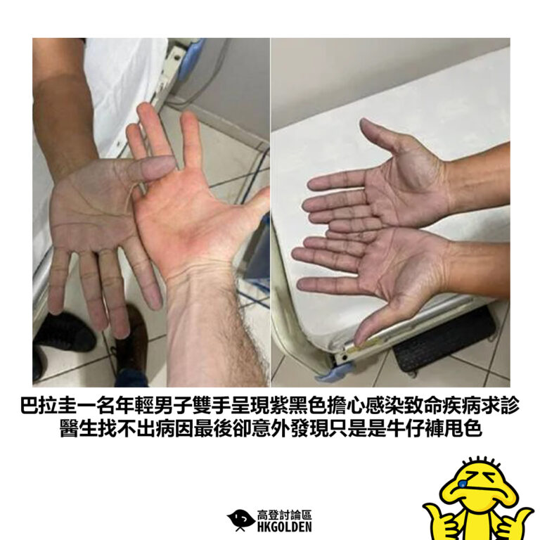 【巴拉圭一名年輕男子雙手呈現紫黑色擔心感染致命疾病求診 醫生找不出病因最後卻意外發現只是是牛仔褲甩色】
