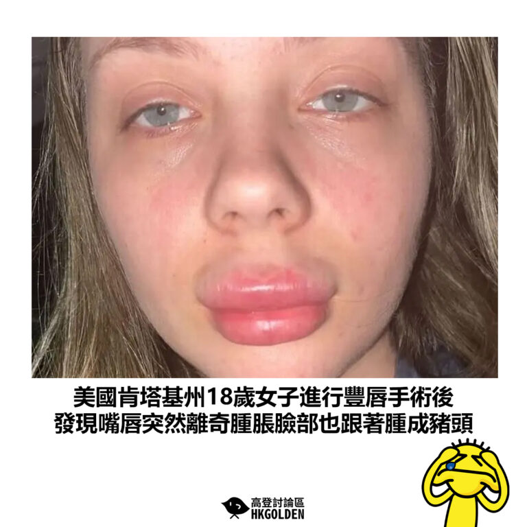 【美國肯塔基州18歲女子進行豐唇手術後 發現嘴唇突然離奇腫脹臉部也跟著腫成豬頭】