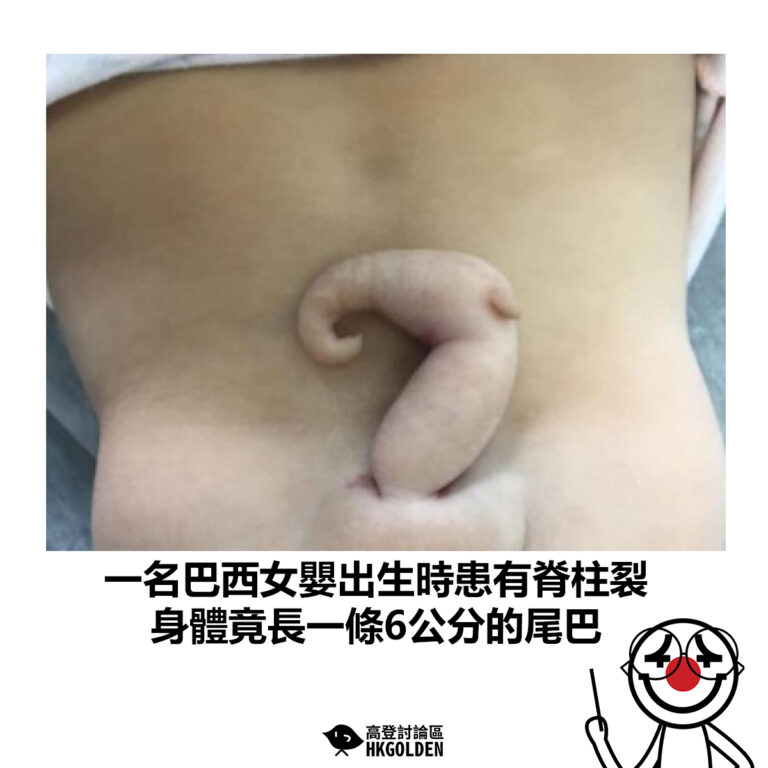 【一名巴西女嬰出生時患有脊柱裂 身體竟長一條6公分的尾巴】