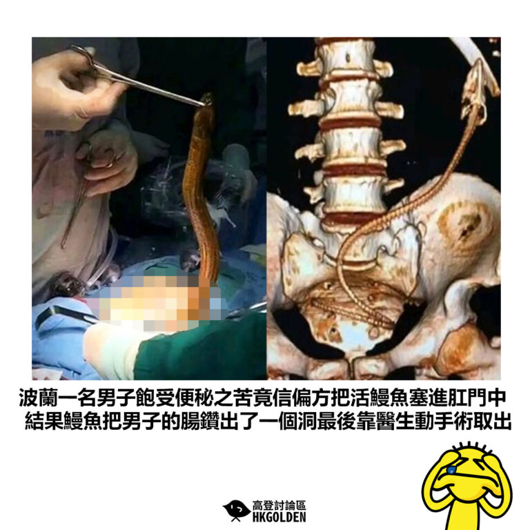 【波蘭一名男子飽受便秘之苦竟信偏方把活鰻魚塞進肛門中 結果鰻魚把男子的腸鑽出了一個洞最後靠醫生動手術取出】