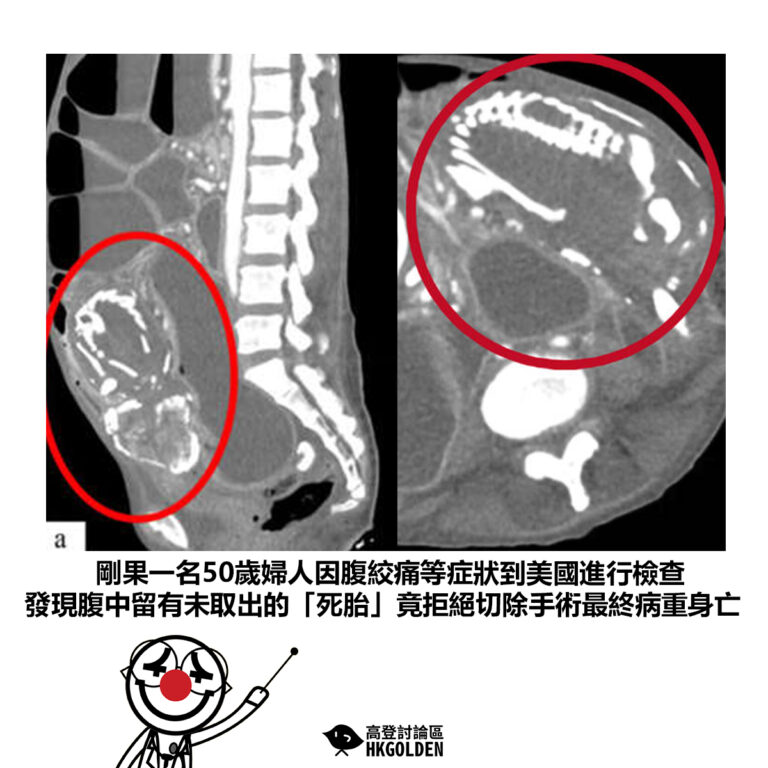 【剛果一名50歲婦人因腹絞痛等症狀到美國進行檢查 發現腹中留有未取出的「死胎」竟拒絕切除手術最終病重身亡】