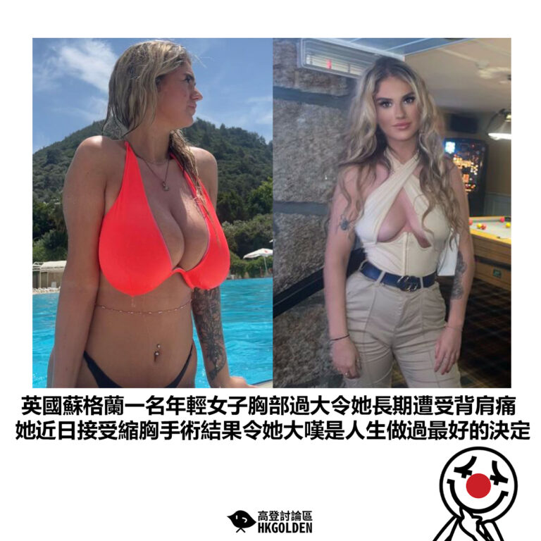 【英國蘇格蘭一名年輕女子胸部過大令她長期遭受背肩痛 她近日接受縮胸手術結果令她大嘆是人生做過最好的決定 】
