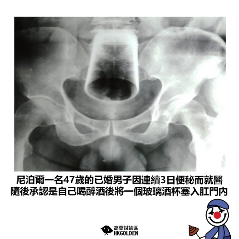 【尼泊爾一名47歲的已婚男子因連續3日便秘而就醫 隨後承認是自己喝醉酒後將一個玻璃酒杯塞入肛門內 】