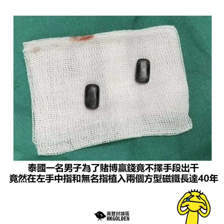 【泰國一名男子為了賭博贏錢竟不擇手段出千 竟然在左手中指和無名指植入兩個方型磁鐵長達40年】