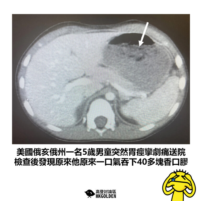 【美國俄亥俄州一名5歲男童突然胃痙攣劇痛送院 檢查後發現原來他原來一口氣吞下40多塊香口膠】