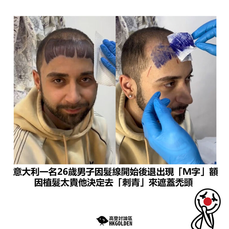 【意大利一名26歲男子因髮線開始後退出現「Ｍ字」額 因植髮太貴他決定去「刺青」來遮蓋禿頭】