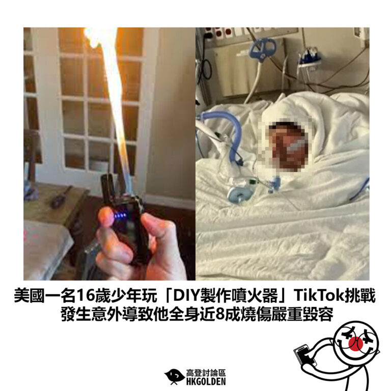 【美國一名16歲少年玩「DIY製作噴火器」TikTok挑戰 發生意外導致他全身近8成燒傷嚴重毀容】
