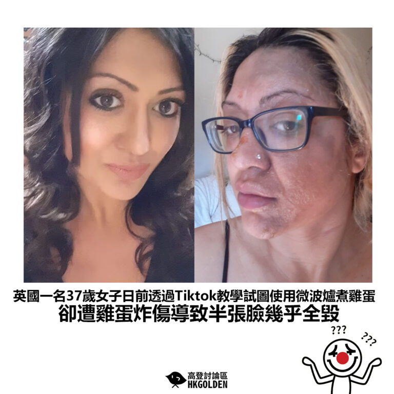 【英國一名37歲女子日前透過Tiktok教學試圖使用微波爐煮雞蛋卻遭雞蛋炸傷導致半張臉幾乎全毀】