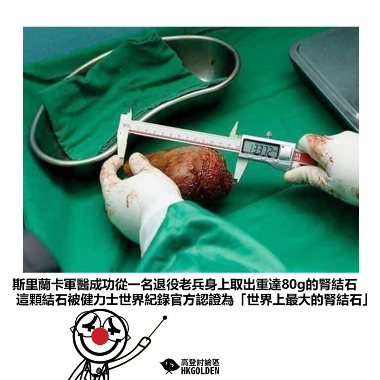 【斯里蘭卡軍醫成功從一名退役老兵身上取出重達80g的腎結石 這顆結石被健力士世界紀錄官方認證為「世界上最大的腎結石」】