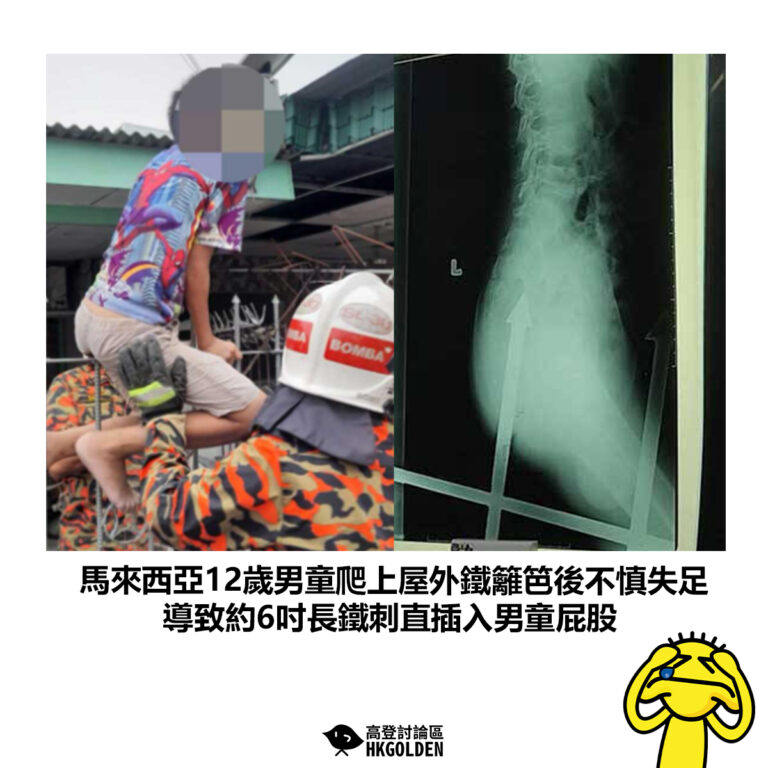 【馬來西亞12歲男童爬上屋外鐵籬笆後不慎失足 導致約6吋長鐵刺直插入男童屁股】