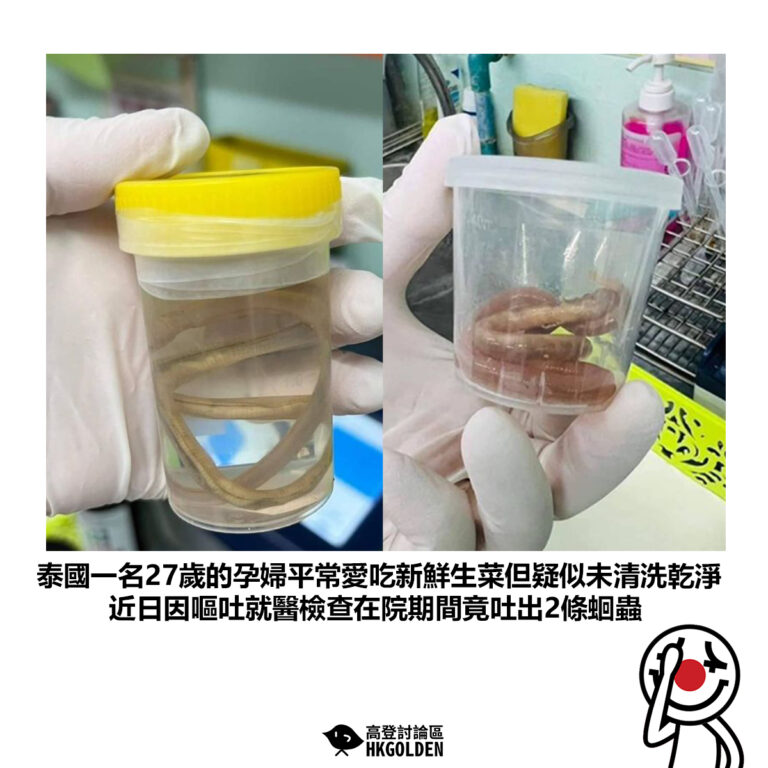 【泰國一名27歲的孕婦平常愛吃新鮮生菜但疑似未清洗乾淨 近日因嘔吐就醫檢查在院期間竟吐出2條蛔蟲】