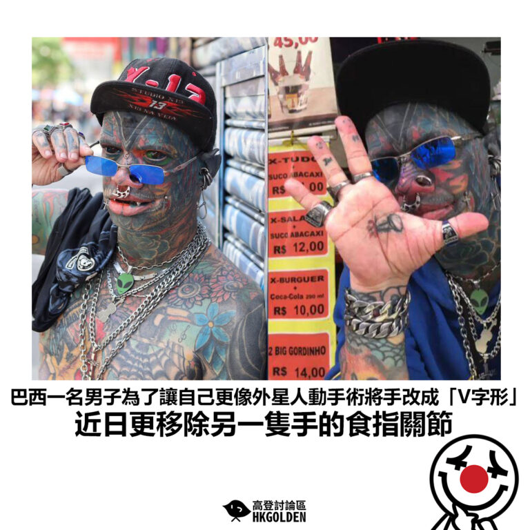 【巴西一名男子為了讓自己更像外星人動手術將手改成「V字形」近日更移除另一隻手的食指關節】