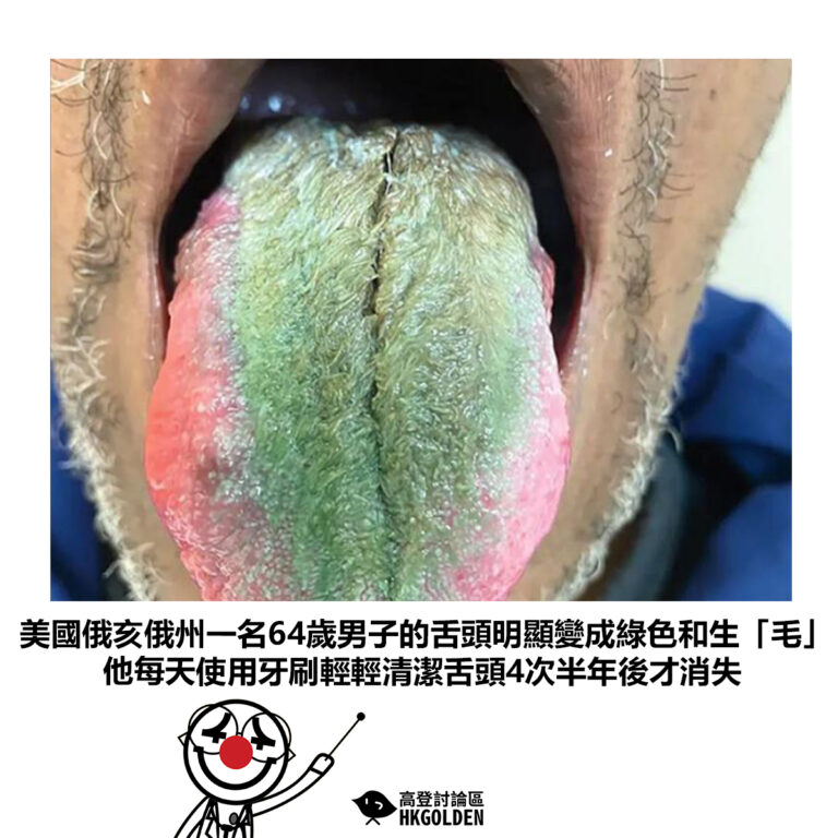 【美國俄亥俄州一名64歲男子的舌頭明顯變成綠色和生「毛」他每天使用牙刷輕輕清潔舌頭4次半年後才消失】
