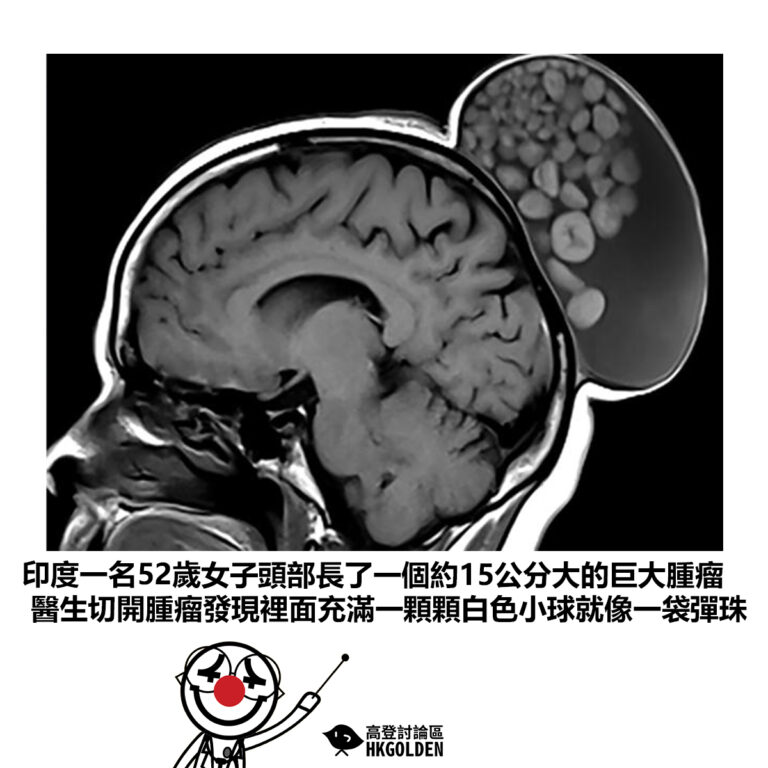 【印度一名52歲女子頭部長了一個約15公分大的巨大腫瘤 醫生切開腫瘤發現裡面充滿一顆顆白色小球就像一袋彈珠】