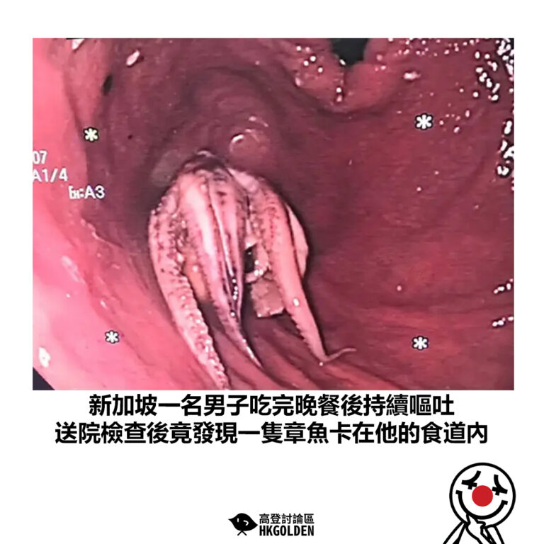【新加坡一名男子吃完晚餐後持續嘔吐 送院檢查後竟發現一隻章魚卡在他的食道內】