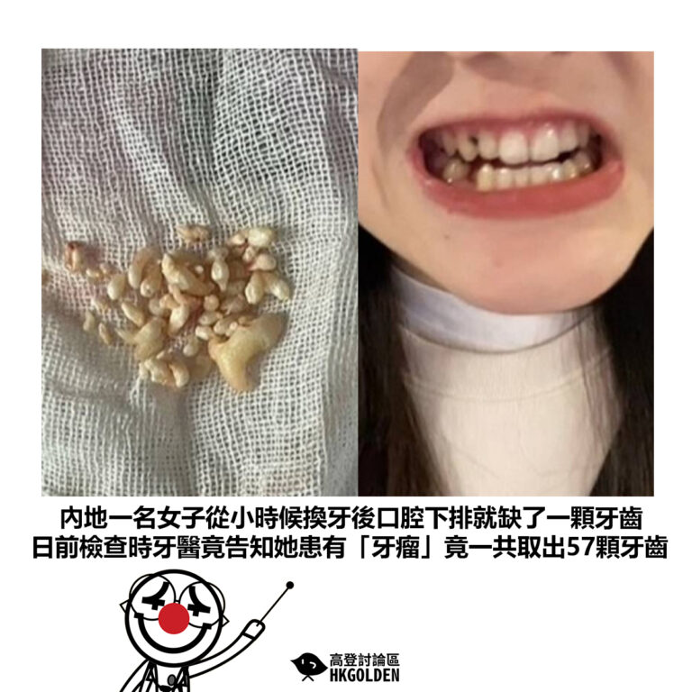 【內地一名女子從小時候換牙後口腔下排就缺了一顆牙齒 日前檢查時牙醫竟告知她患有「牙瘤」竟一共取出57顆牙齒】