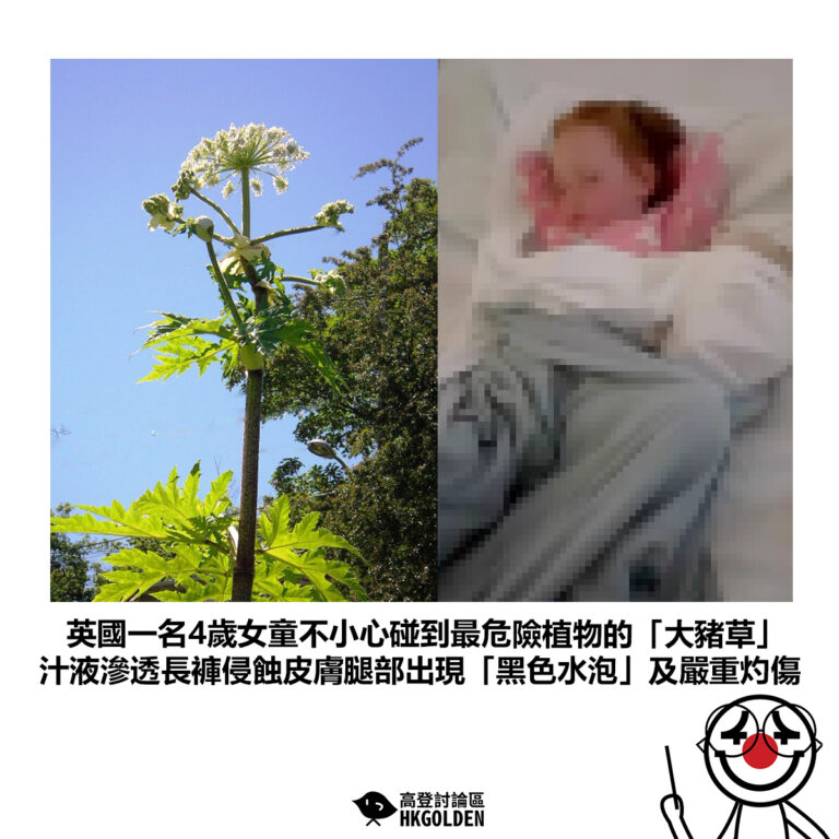 【英國一名4歲女童不小心碰到最危險植物的「大豬草」汁液滲透長褲侵蝕皮膚腿部出現「黑色水泡」及嚴重灼傷】