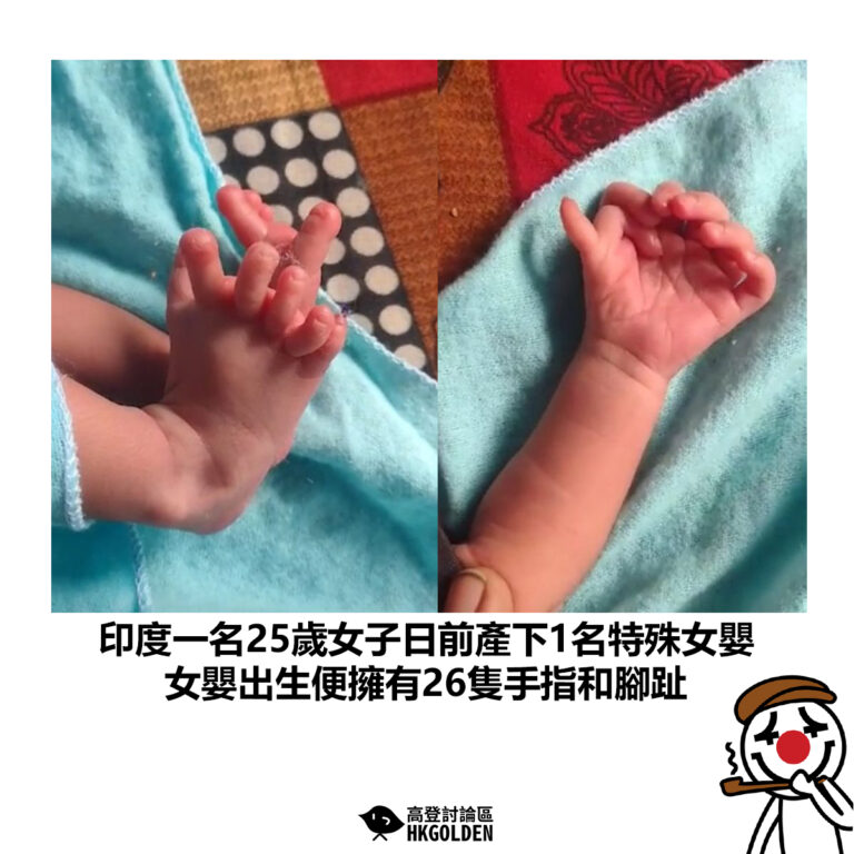 【印度一名25歲女子日前產下1名特殊女嬰 女嬰出生便擁有26隻手指和腳趾】
