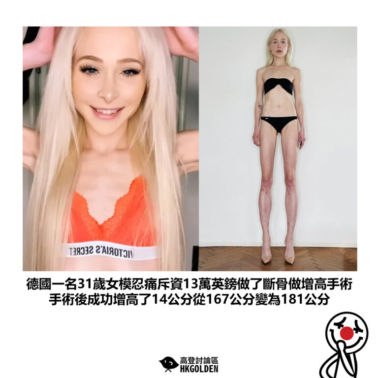【德國一名31歲女模忍痛斥資13萬英鎊做了斷骨做增高手術 手術後成功增高了14公分從167公分變為181公分】