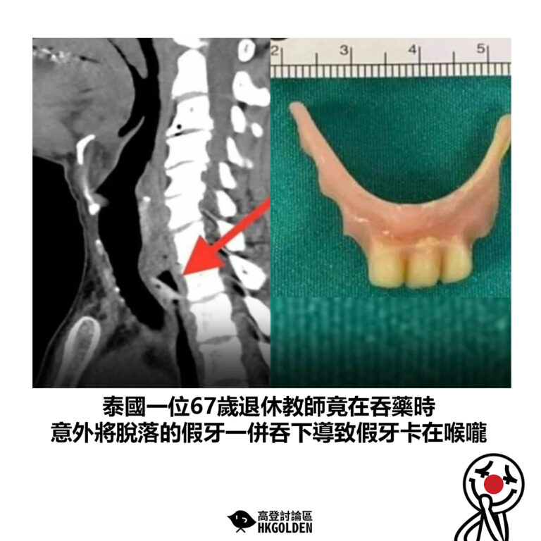 【泰國一位67歲退休教師竟在吞藥時 意外將脫落的假牙一併吞下導致假牙卡在喉嚨】