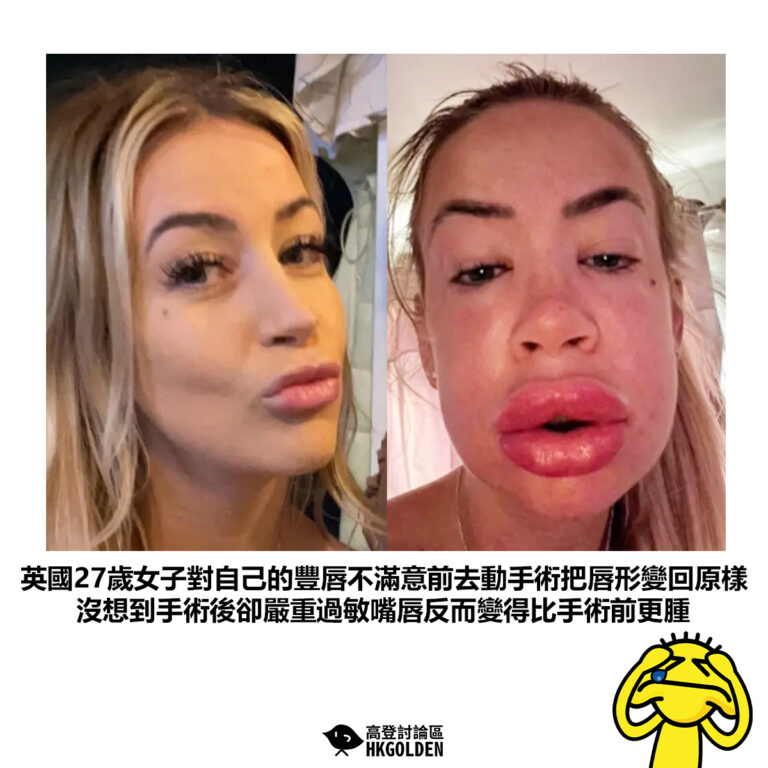 【英國27歲女子對自己的豐唇不滿意前去動手術把唇形變回原樣沒想到手術後卻嚴重過敏嘴唇反而變得比手術前更腫】