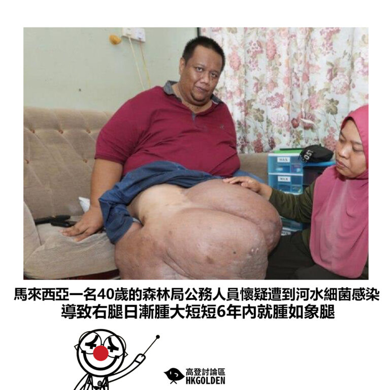 【馬來西亞一名40歲的森林局公務人員懷疑遭到河水細菌感染 導致右腿日漸腫大短短6年內就腫如象腿】
